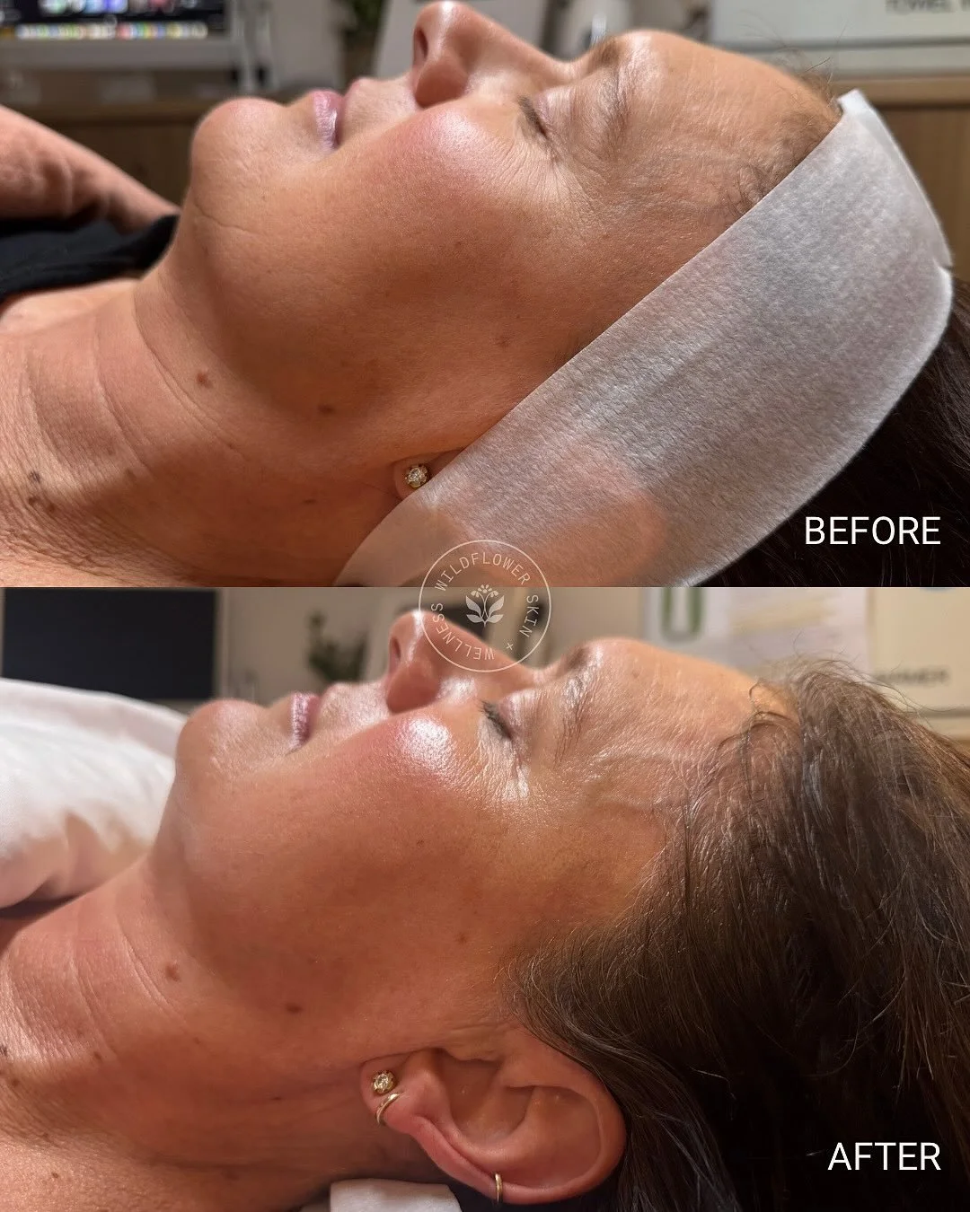 ✨The Byonik Laser is the world&rsquo;s only pulse-triggered laser that works in sync with your heartbeat to infuse medical-grade hyaluronic acid + antioxidants deep into the skin.

As we age, our natural hyaluronic acid levels decline, leading to fin
