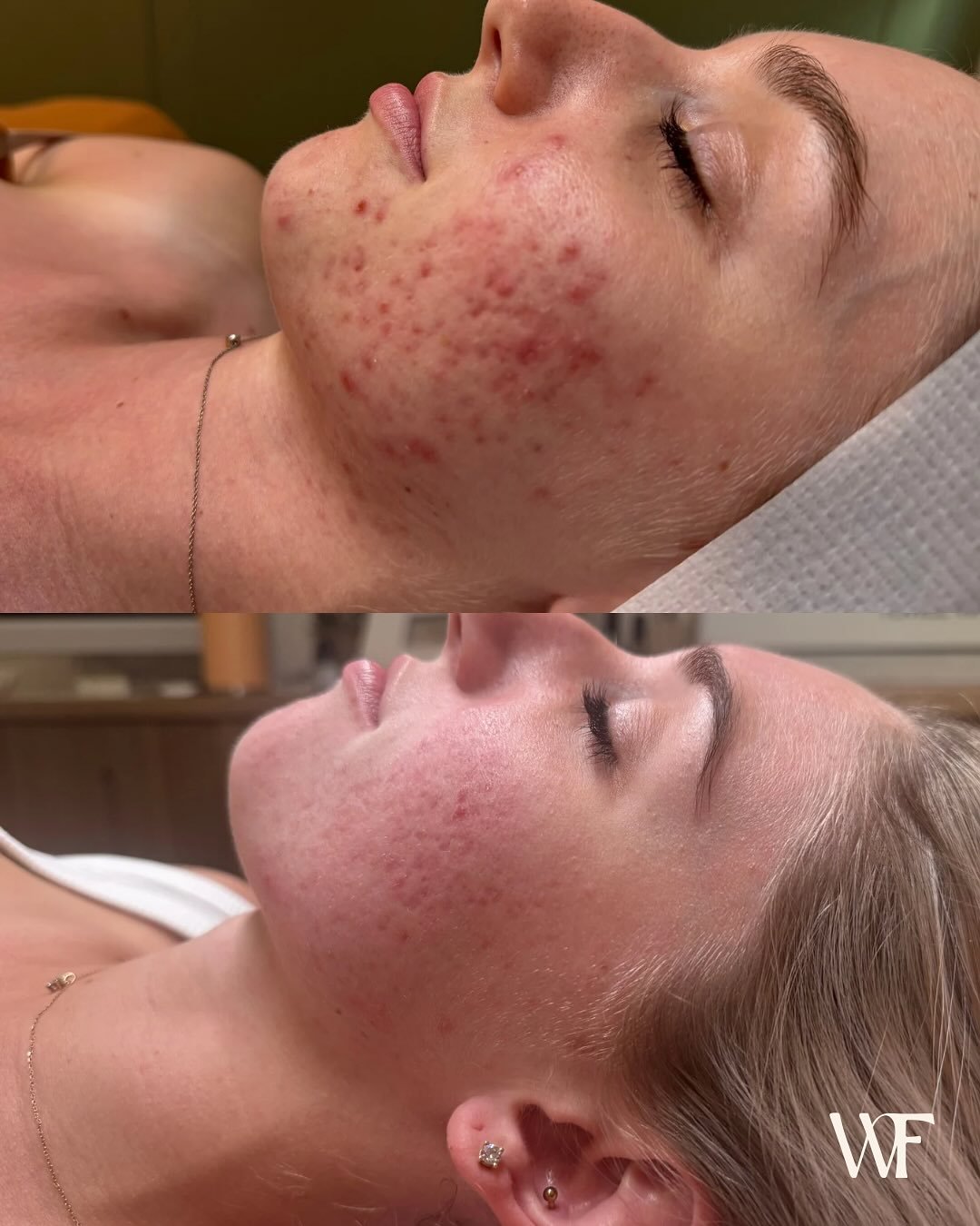 Consistency always wins.💫

This beauty has been showing up for her treatments and sticking to her home routine &mdash; and her results speak for themselves.✨

When you commit to your skin, your skin commits back. 🫧🤍

We&rsquo;re now on 2/8 Jet Col