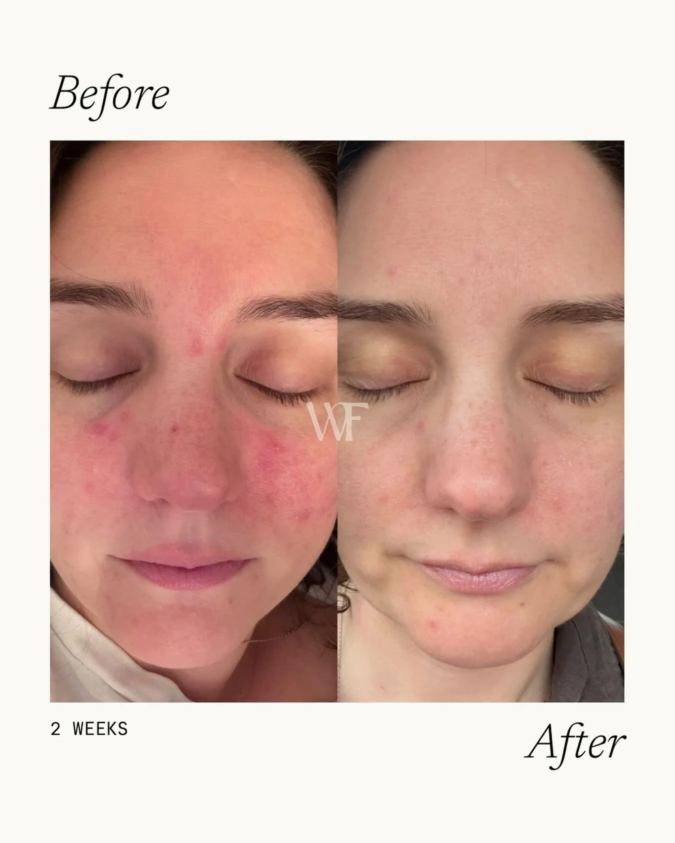 Sometimes when our skin suddenly flares up and we don&rsquo;t know why, the best thing we can do is slow everything down..🐌

With Candice, we stripped things back to the basics:
&bull; a bespoke @dermaviduals cleanser
&bull; a @simkaskin face cloth
