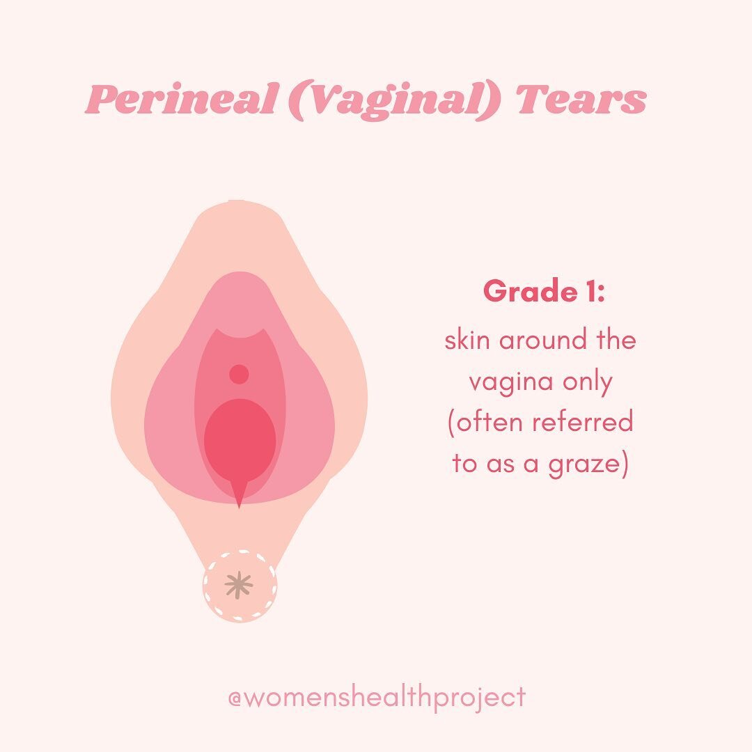 Perineal tears during childbirth⁠⁠
⁠⁠
Most women will sustain some form of tear in their first vaginal delivery. 1️⃣ in 4️⃣ of these tears will be significant and may cause pelvic floor dysfunction in the future⁠⁠
⁠⁠
⭐1st/2nd degree tear⭐⁠⁠
The major