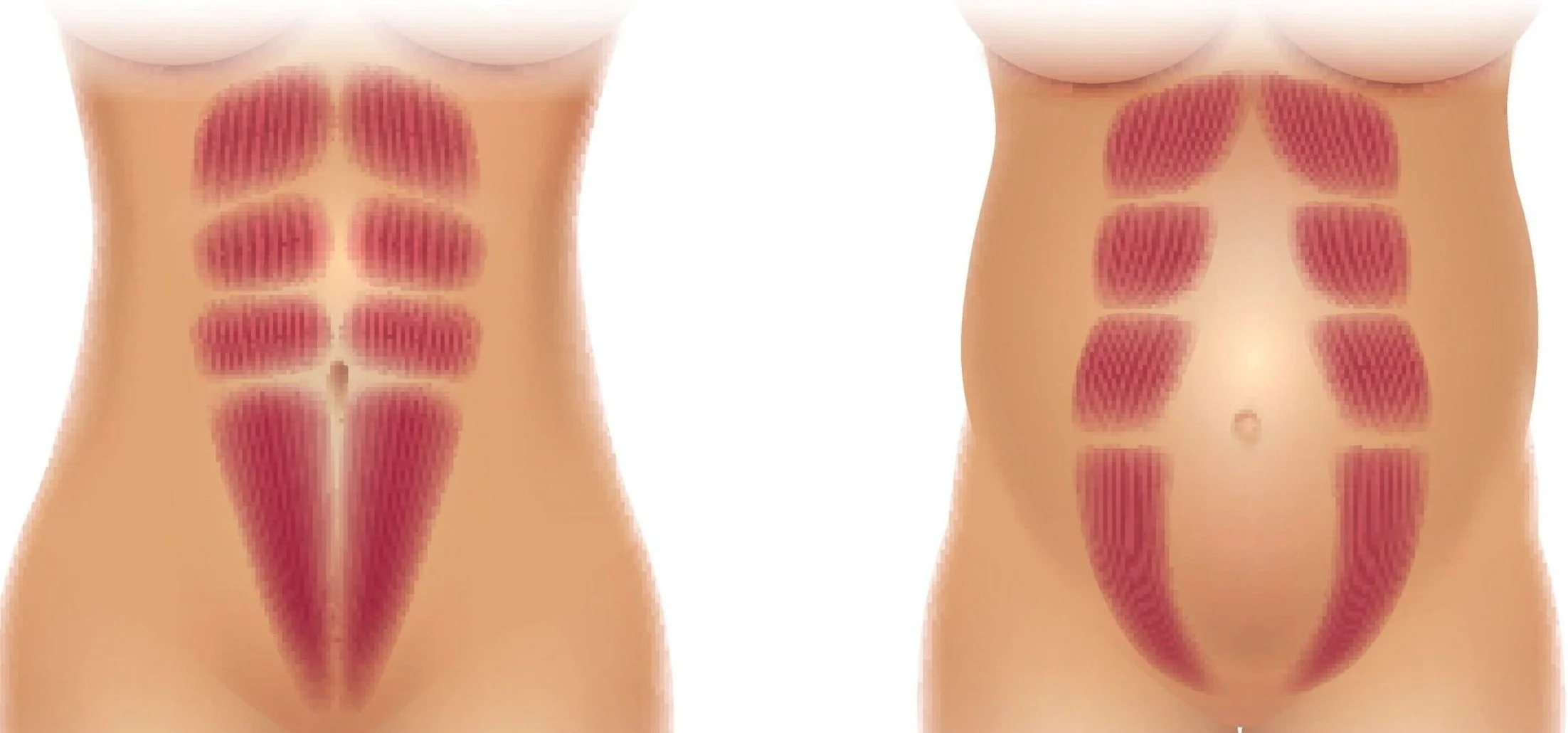 abdominal separation.jpg