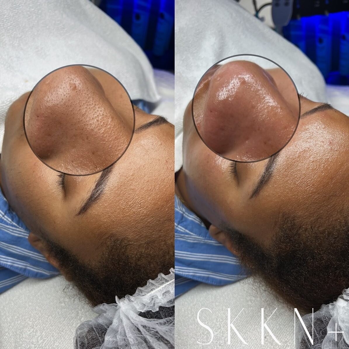 + | We love extractions! Available with all of our customized/advanced/hydra-facials. Upgrade your selfie game today! 🤳 
+
+
Thank you all for choosing SKKN+ for your skincare needs. Let&rsquo;s start your journey towards healthy skin! 🌱🧖&zwj;♀️
+