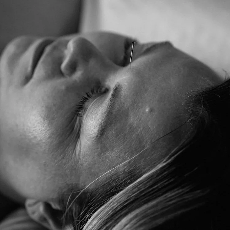Facial Acupuncture: Cosmetic & Somatic Therapy in One
