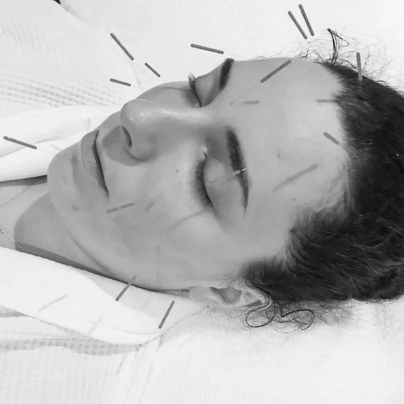 Why Facial Acupuncture Is the Holistic Alternative to Botox Everyone’s Talking About