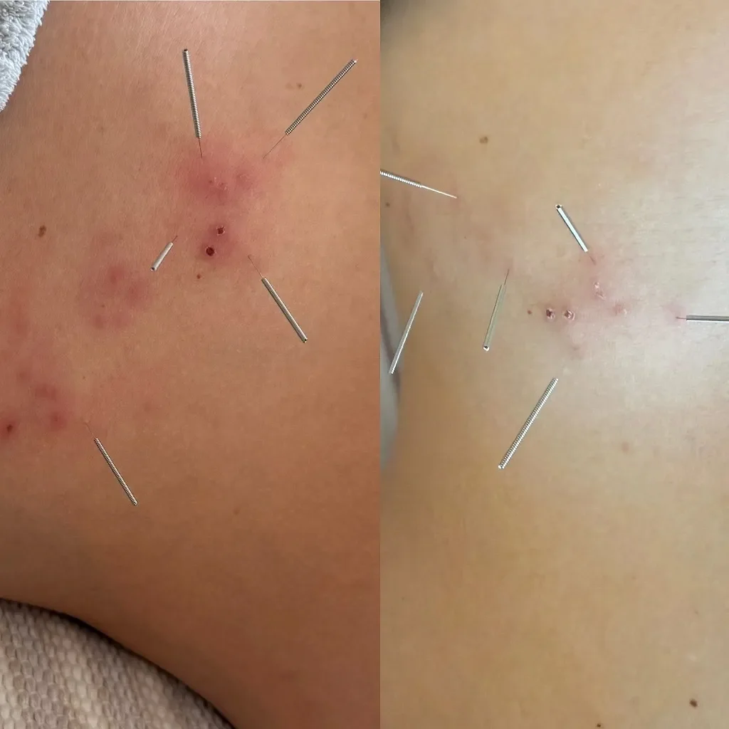 Herpes Zoster Treatment Before After Salt Lake Retreatment Wellness