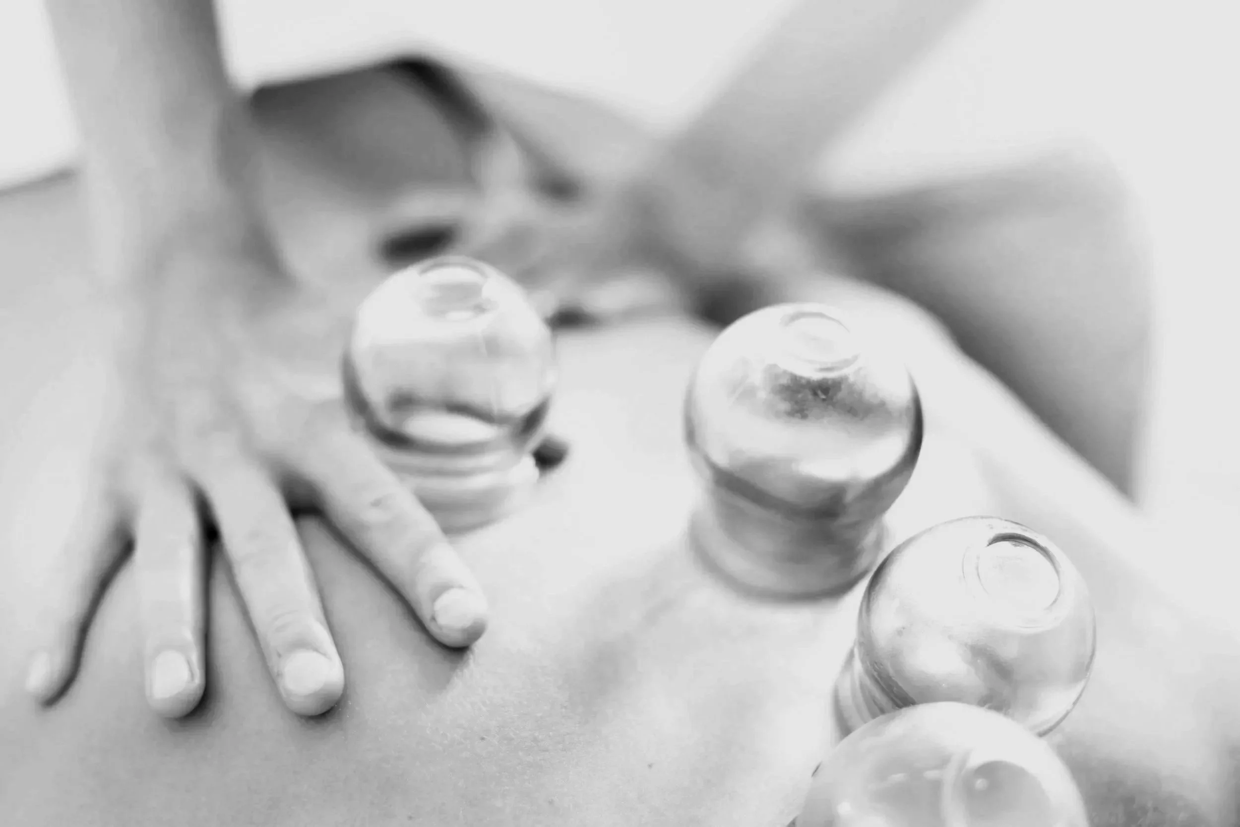 Close up of cupping therapy on a back to relief pain and improve health