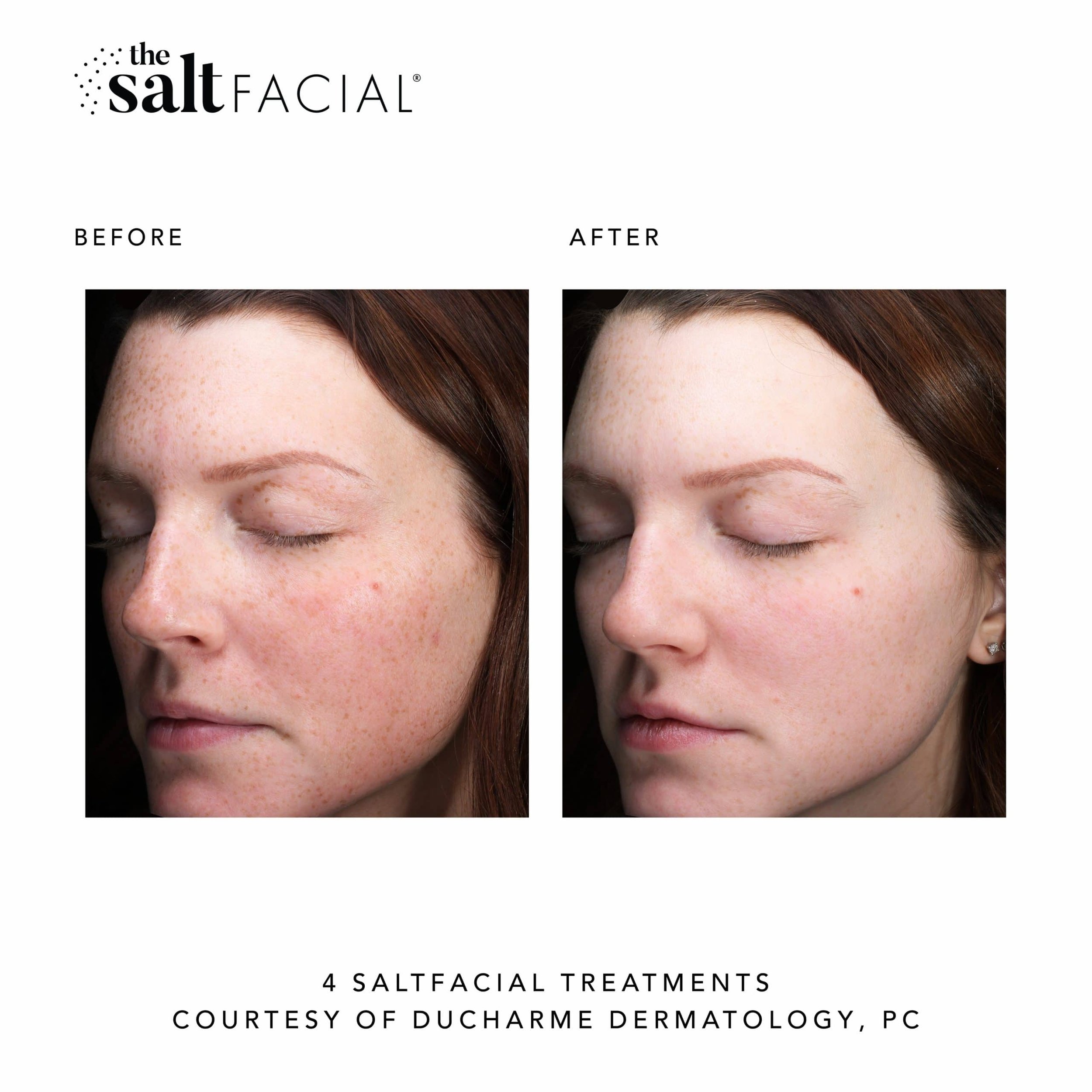 SaltFacial_BeforeAfter8_3-1-scaled.jpg