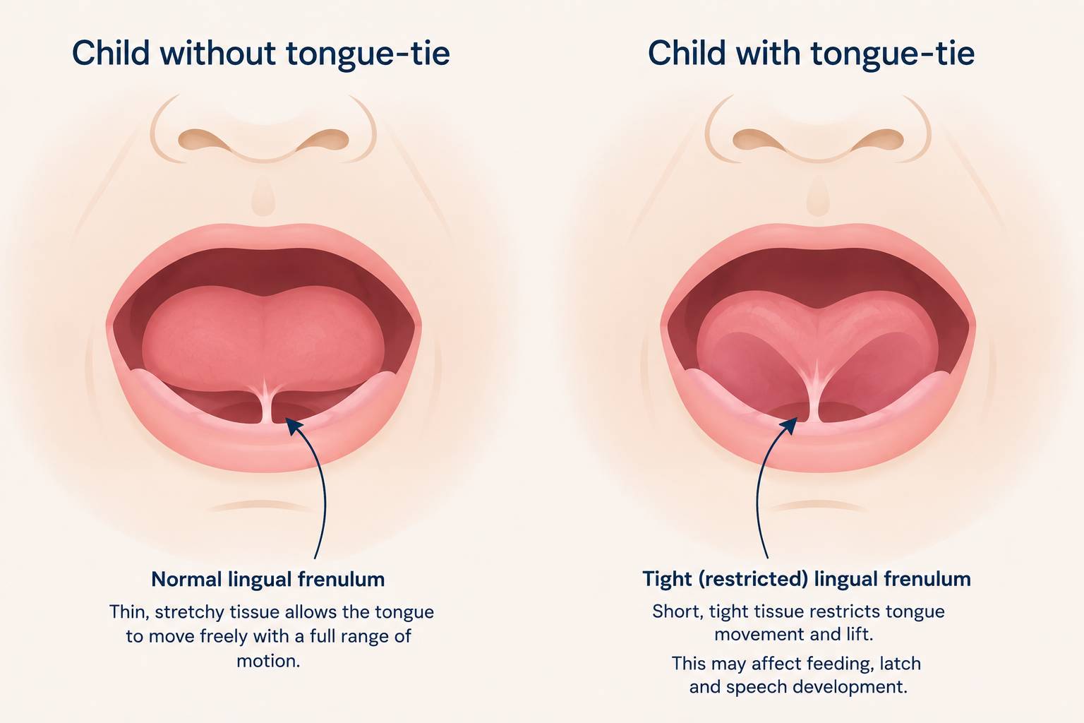 Tongue Tie in Babies: Signs, Symptoms, Treatment and How Osteopathy Can Help