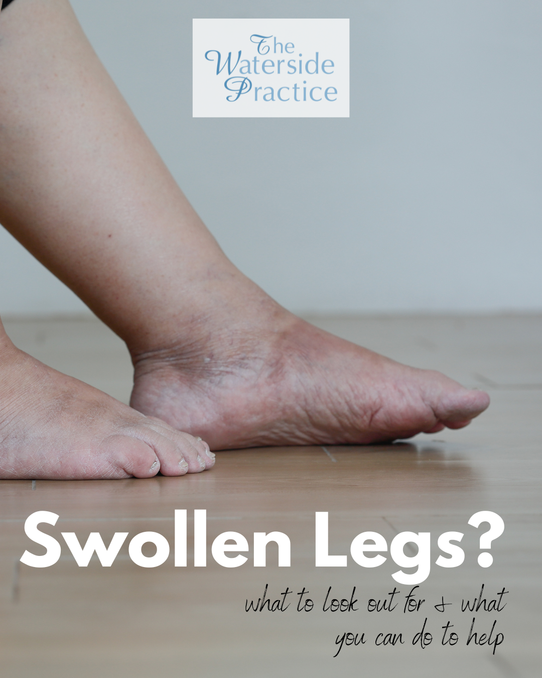 Swollen Legs: What to look out for &amp; self help guidance