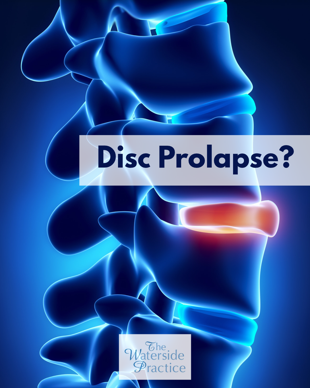 Back pain after lumbar fusion: why might another disc become a problem?