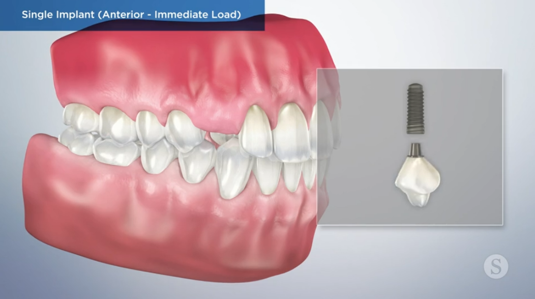 Replacing a Missing Tooth with a Dental Implant