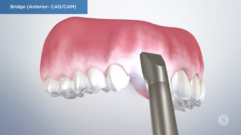 Scanning the Missing Tooth Using 3D Imaging