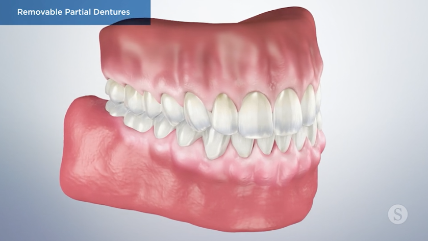 The Case for Removable Partial Dentures