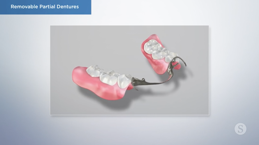 Crafting the Removable Partial Denture