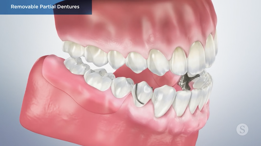 Eating with the Partial Removable Denture