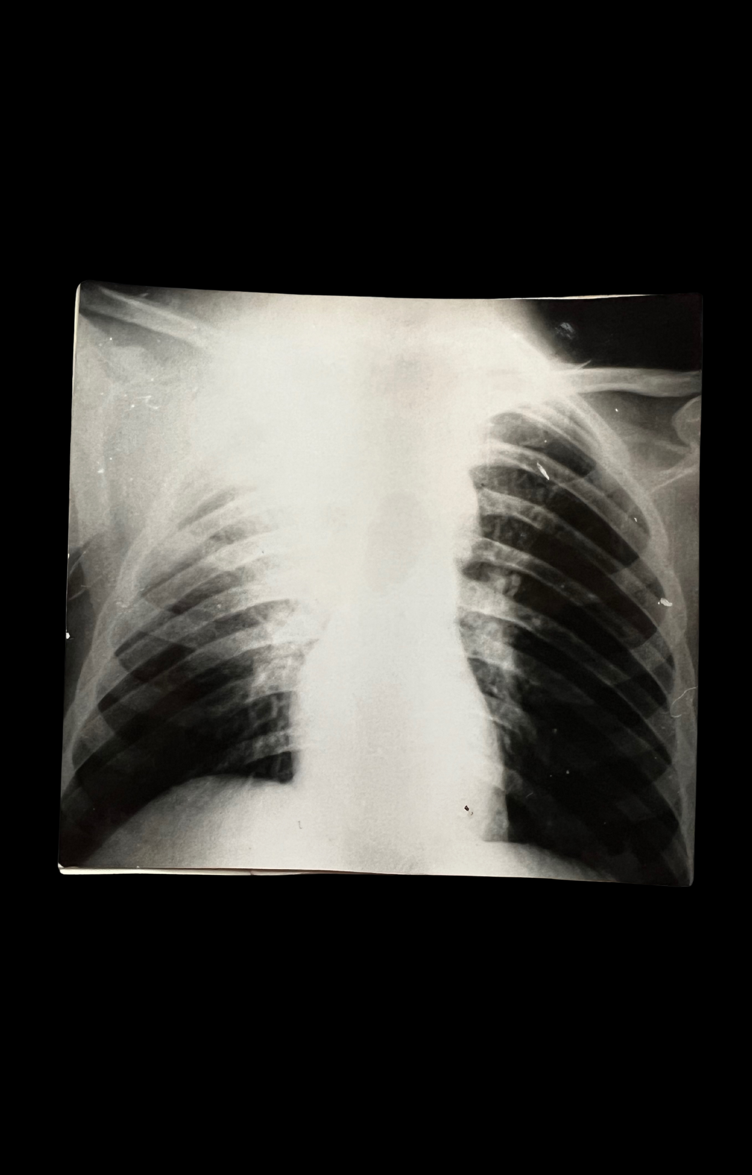 Chest X-Ray, Photograph, c. 1960