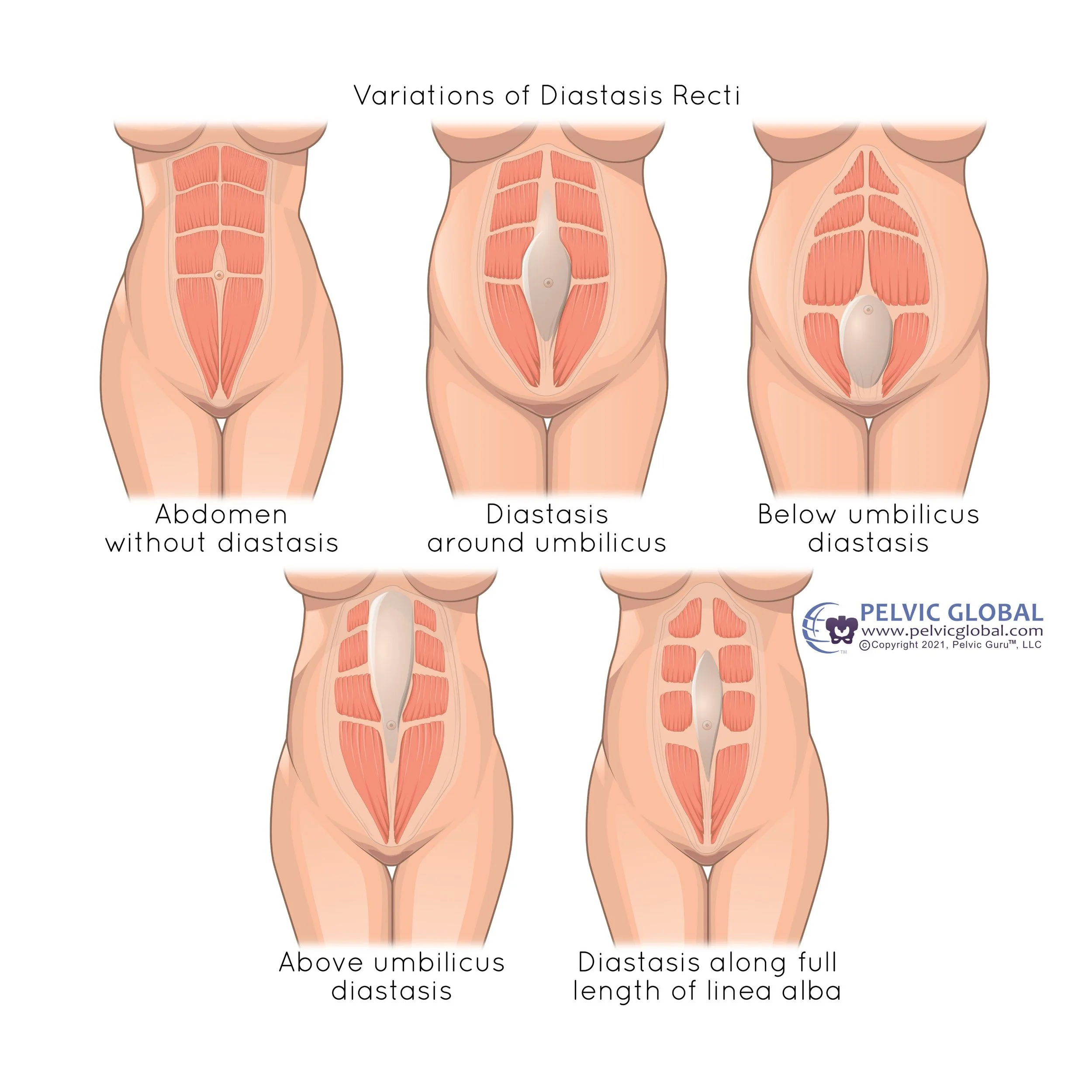 Illustration of the abdominal wall showing diastasis recti patterns (linea alba separation) above, at, and below the belly button