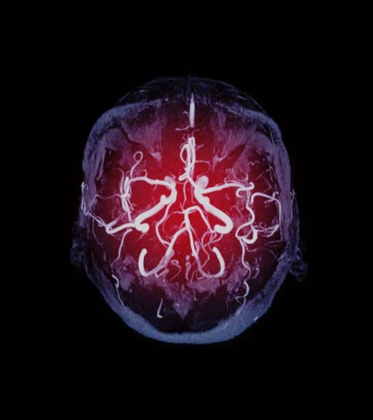 Chapter 12: Central nervous system vasculitis