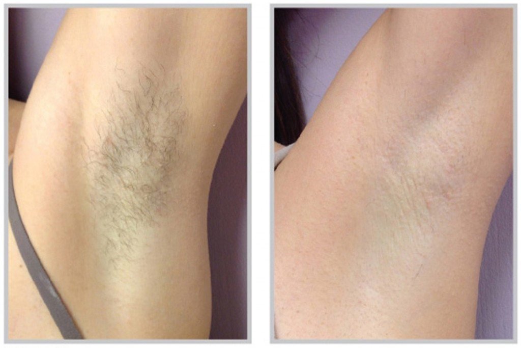 synergy_before-after-laser-hair-removal-female-male-armpits-back-face-1-1024x683.jpeg