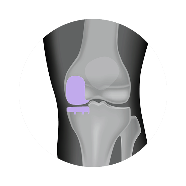 Types of knee surgeries — UNOVA Hip & Knee Center I Best Surgeons for