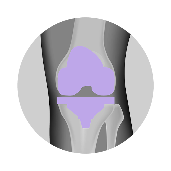 Types of knee surgeries — UNOVA Hip & Knee Center I Best Surgeons for