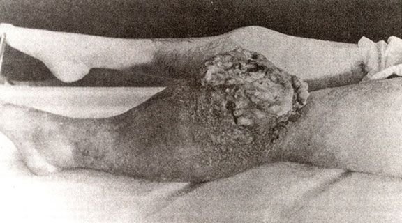 A tumor caused by radiation poisoning.