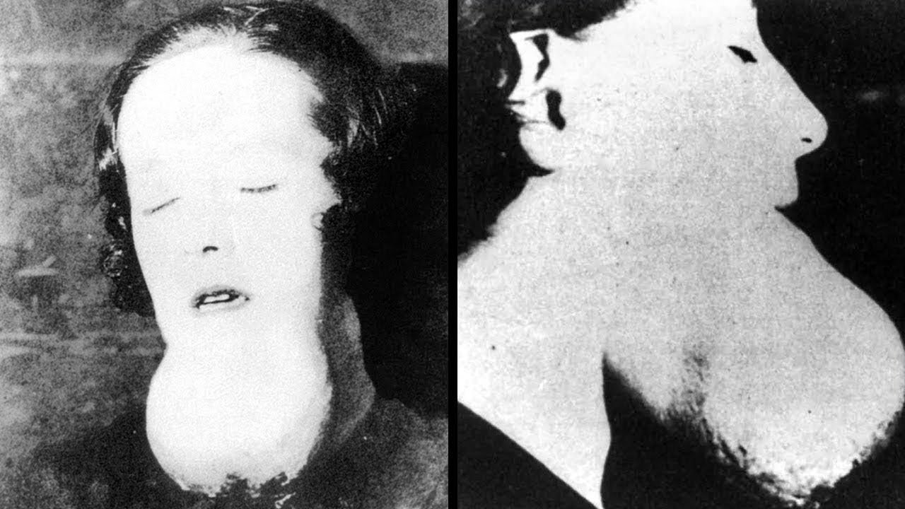 A tumor of the jaw caused by radiation poisoning.