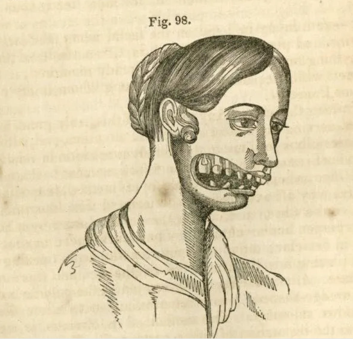 A drawing showcasing the ravages of radiation poisoning.