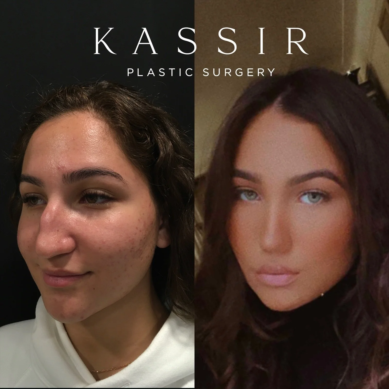 Best Rhinoplasty I Designer Rhinoplasty by Dr. Kassir — Kassir Plastic