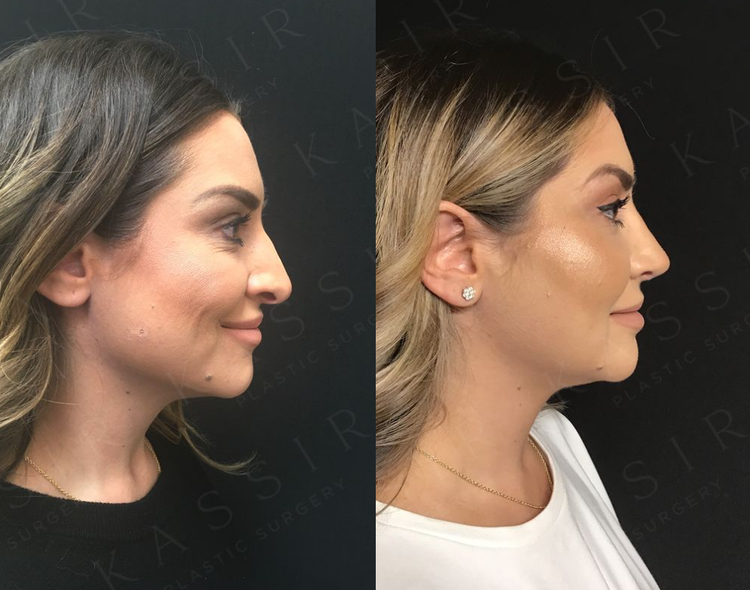 Revision Rhinoplasty Patient