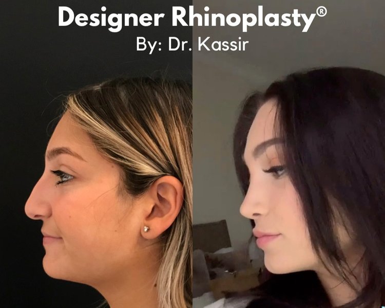 Three years after rhinoplasty