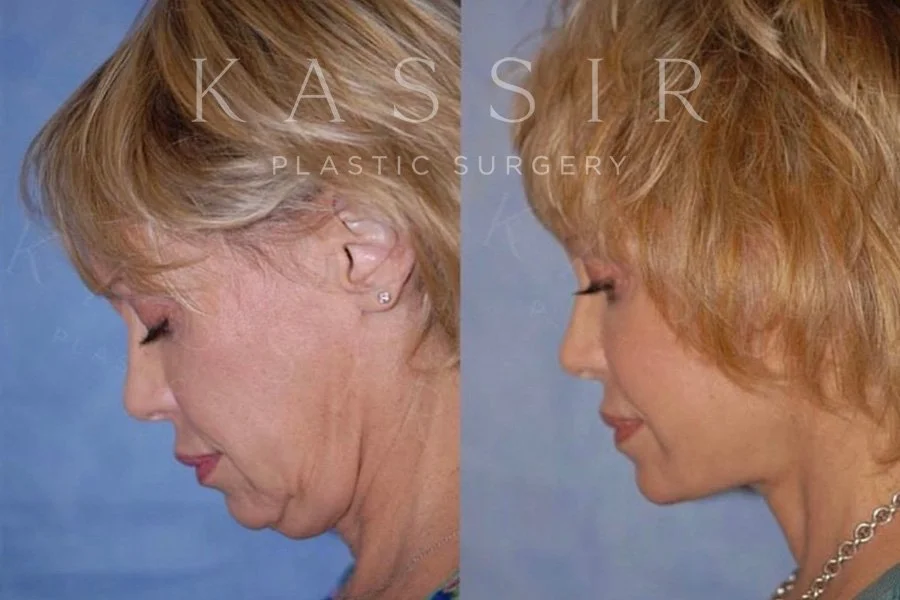 Facelift Before and After