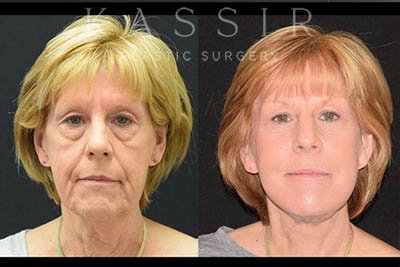 Before and After Designer Face and Necklift®️