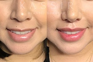 LipLift5 FV Thumbnail.jpg