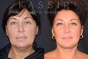 1 year after  Face and Neck Lift  by Dr. Kassir