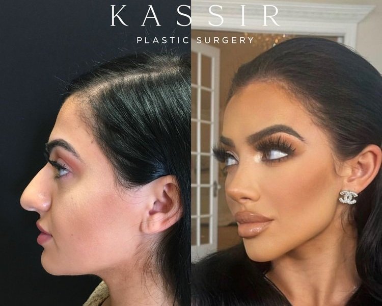 Before and after Nose Job