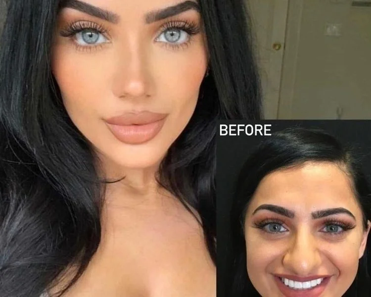  Her nose now is narrow and suits her facial profile much better.  