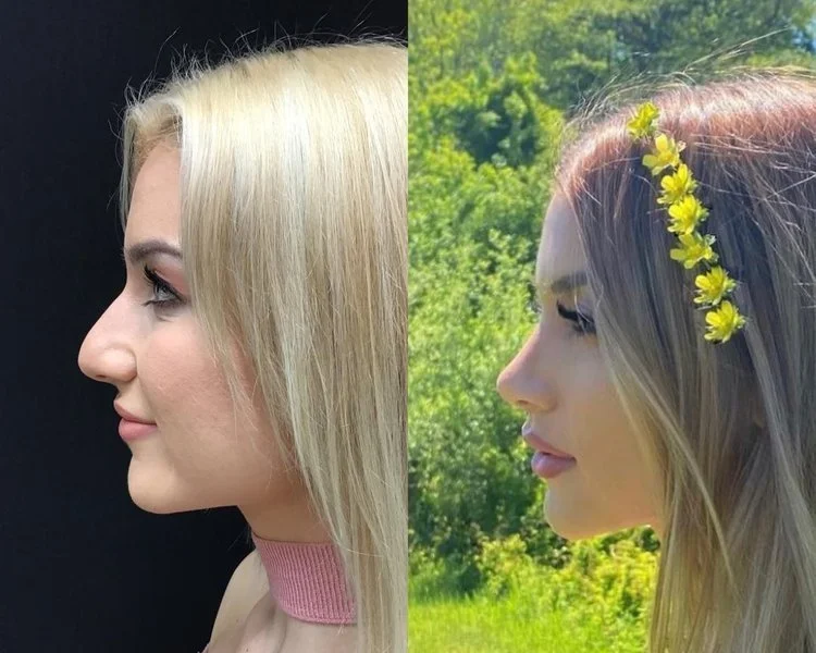 Rhinoplasty Before and After