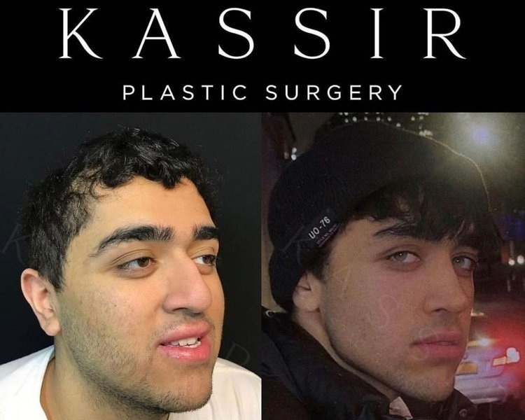 Best Male Rhinoplasty Before and After