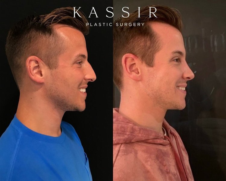 One Week Before and After Male Rhinoplasty and Eyelid Surgery