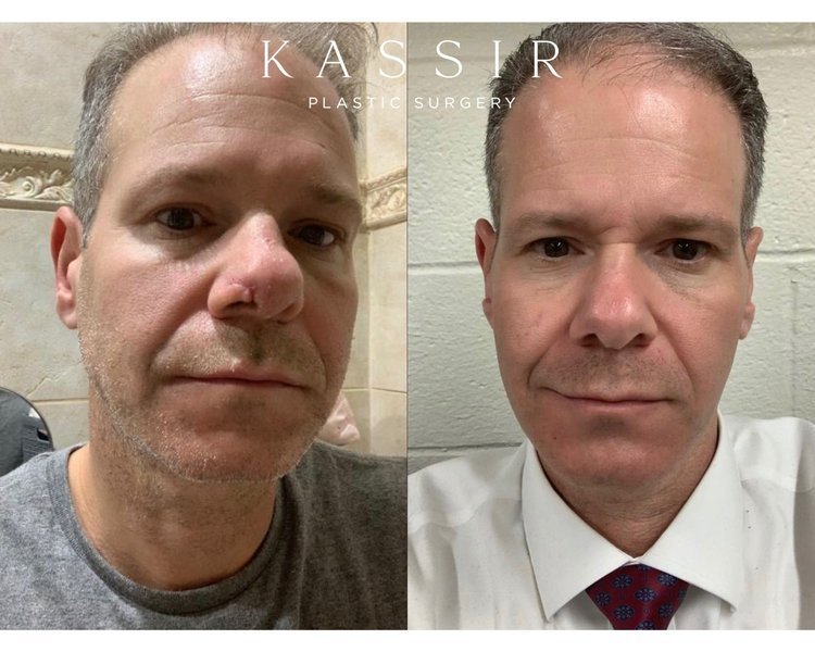 One month after male rhinoplasty re