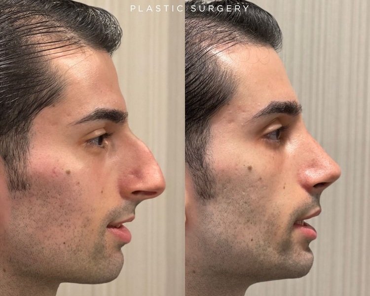 One month after ethnic male nose job