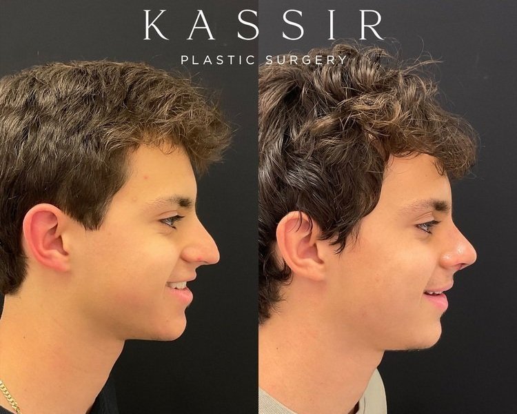 good nose job before and after