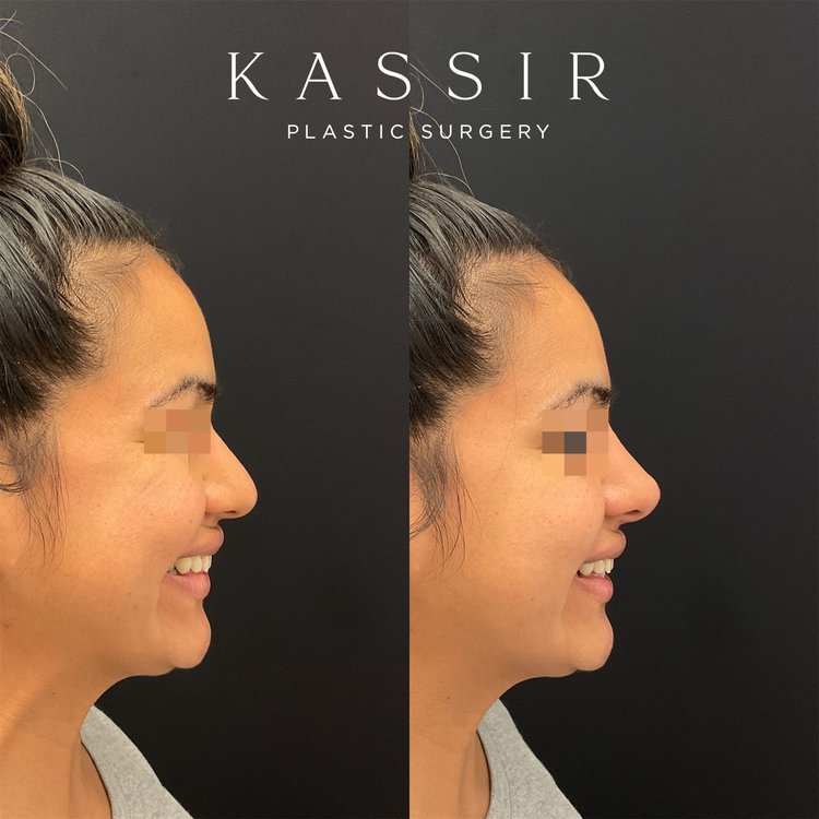  Female patient with slightly convex nose and plunging tip. She wanted to elevate her nasal tip and get more rotation. She looks amazing.  