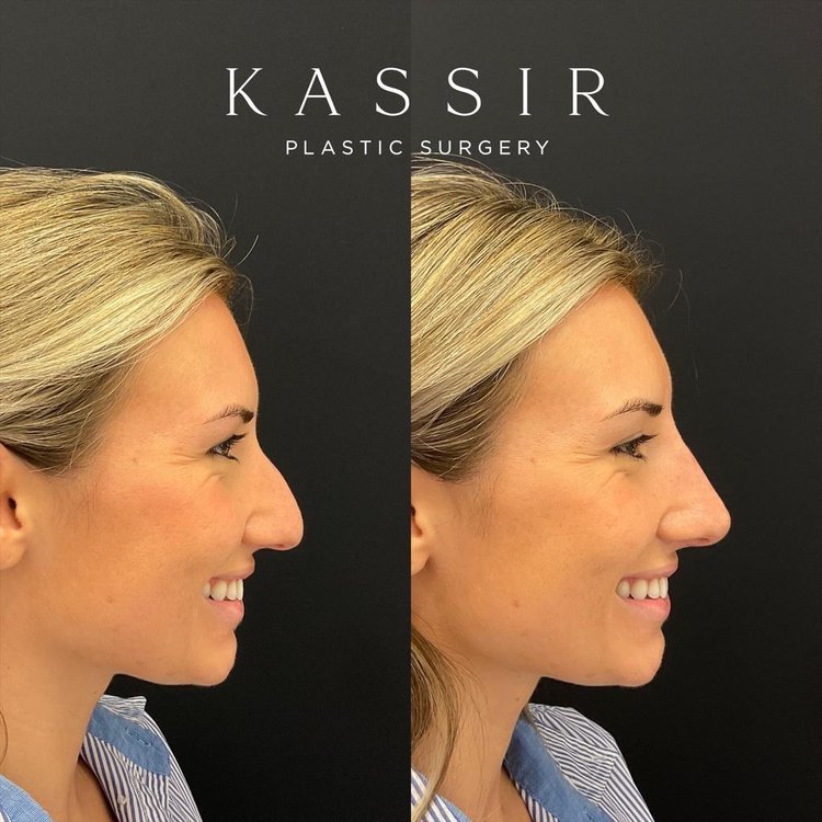  Beautiful patient with a nasal hump and droopy nasal tip. We achieved nasal tip elevation and projection together with a  straight nasal dorsum.  