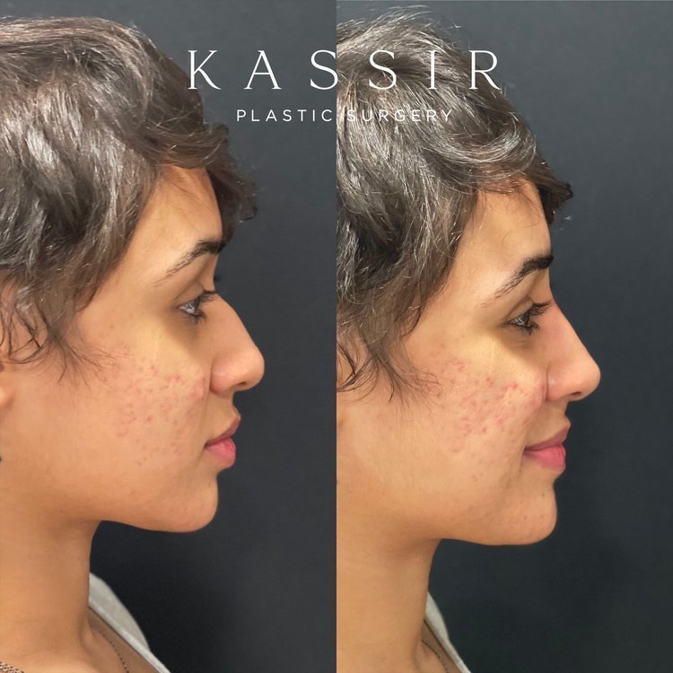  Young female patient with a dorsal nasal hump and under projected nasal tip. She desired a straight side profile with gentle tip projection.  