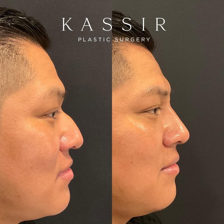 Male Liquid Rhinoplasty Before and After