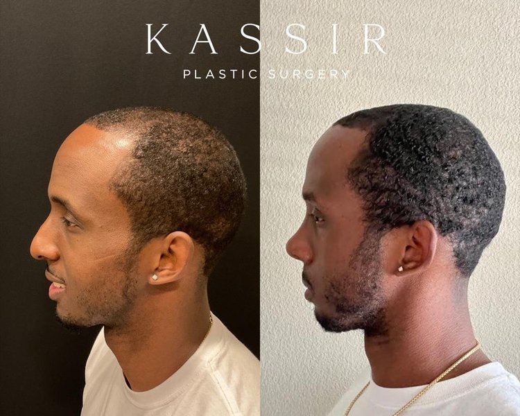 Ethnic Rhinoplasty Before and After Gallery — Kassir Plastic Surgery in NY  and NJ