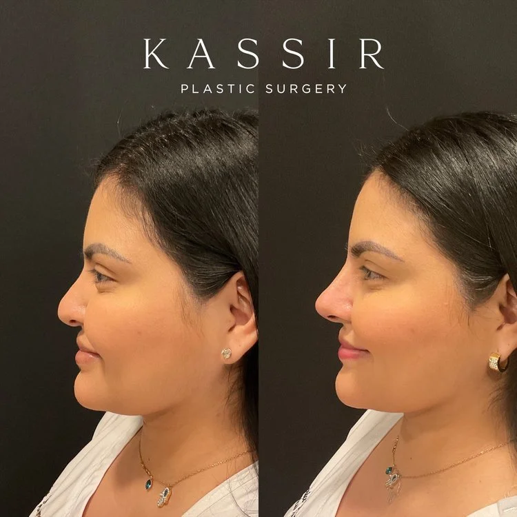 Female Hispanic Rhinoplasty / Ethnic Rhinoplasty — Kassir Plastic