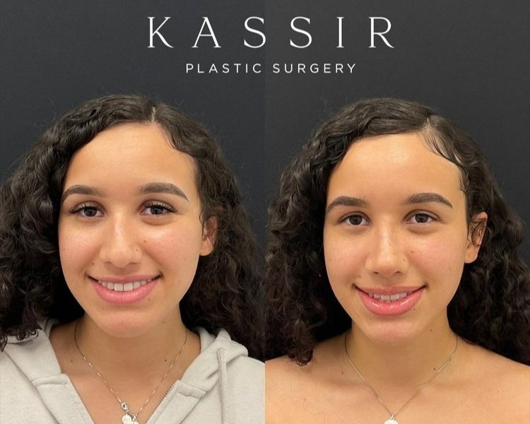 Ethnic Rhinoplasty Before and After Gallery — Kassir Plastic Surgery in